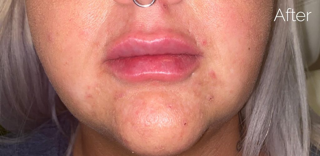 Before lip enhancement treatment