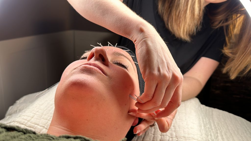 Women receiving facial acupuncture in Gilbert, AZ Onyx location.