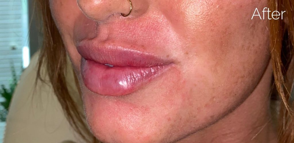lip filler after