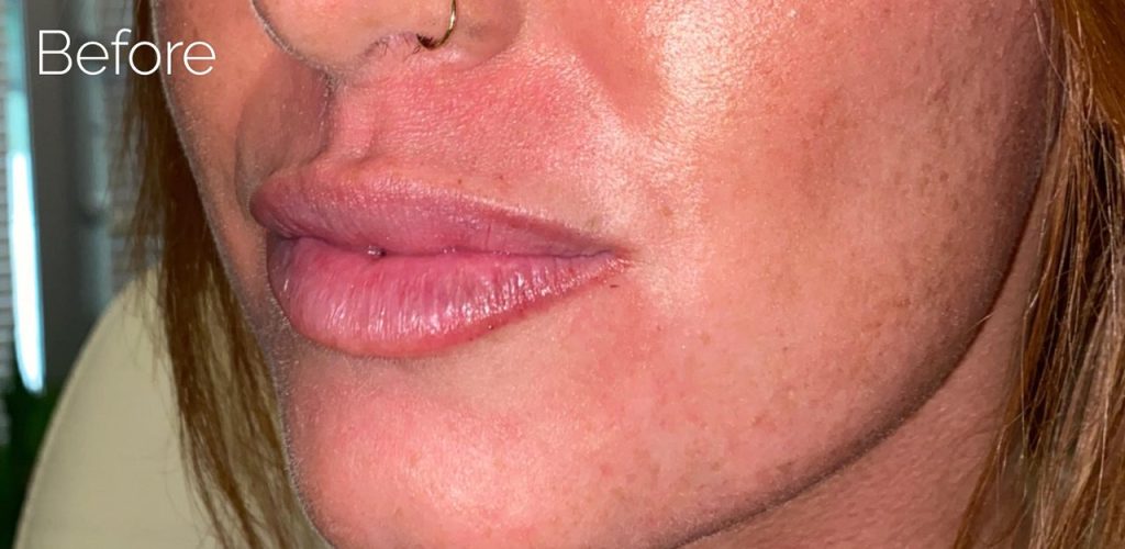 Lip Filler Before