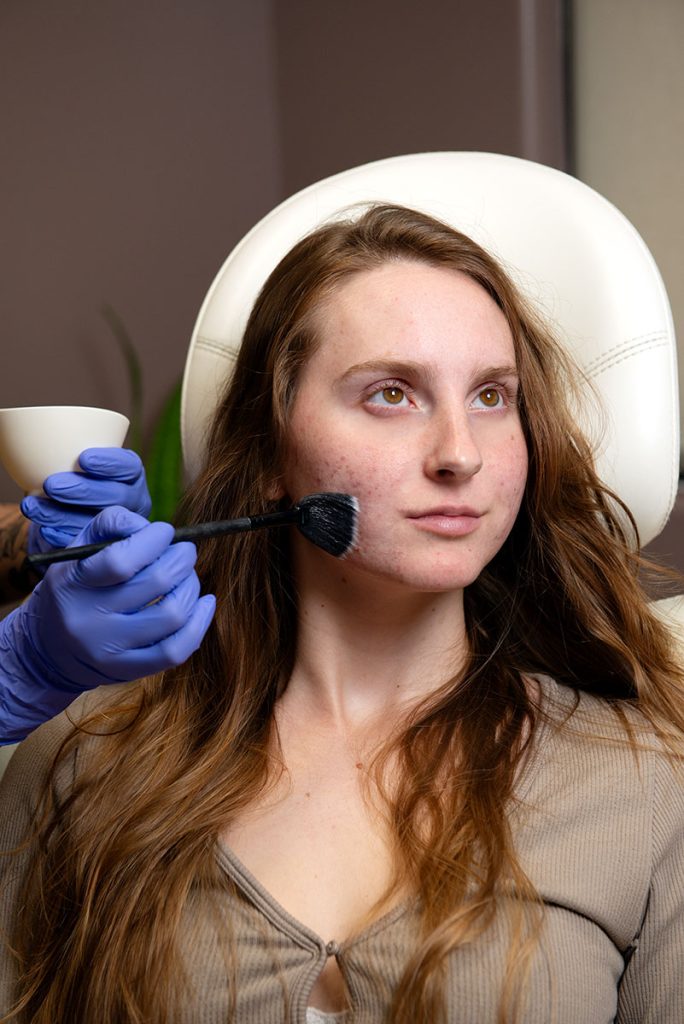 Madison Applying Facial Peel for Acne Treatment