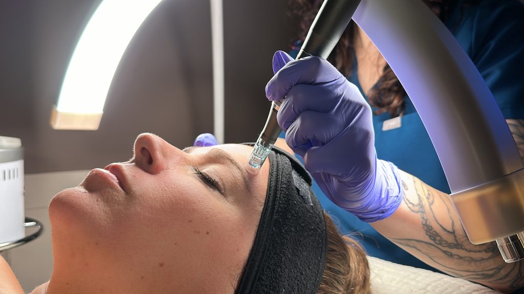 Microneedling treatment by Madison on Gilbert AZ patient at Onyx integrative.