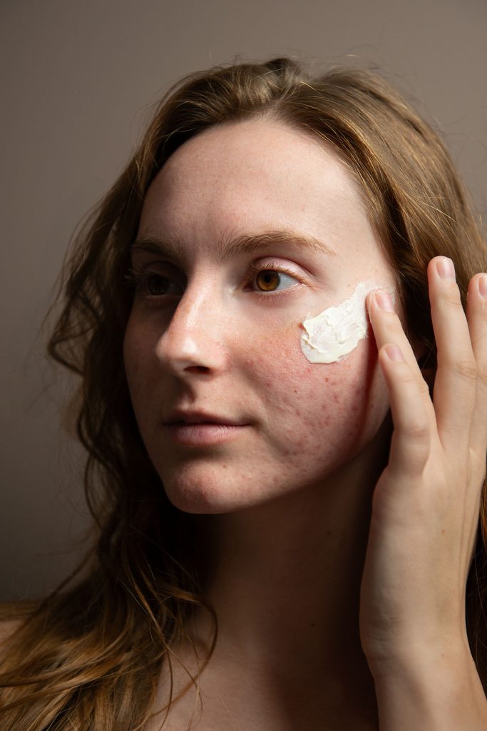 Women applying facial cream to her acne
