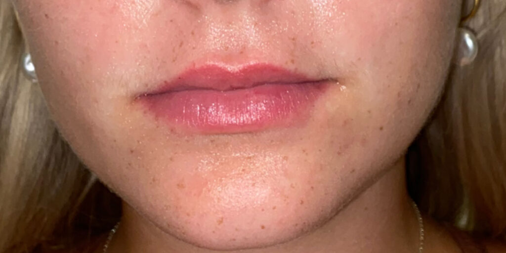 lip fillers favorite Layer