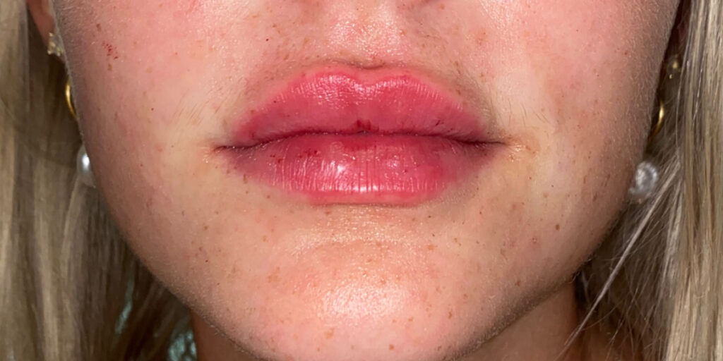 lip fillers favorite After