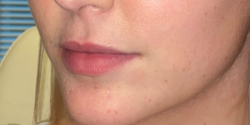 lip fillers gilbert az before after