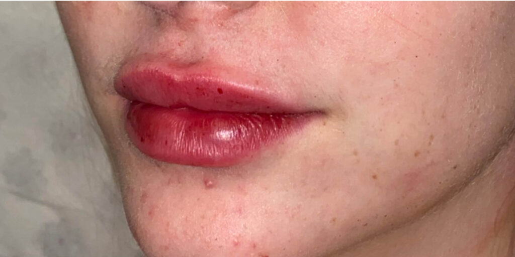 lip fillers gilbert az before after 2