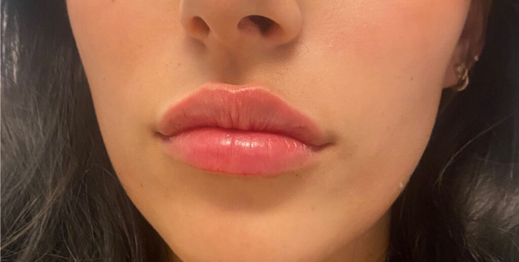 lip fillers in gilbert after