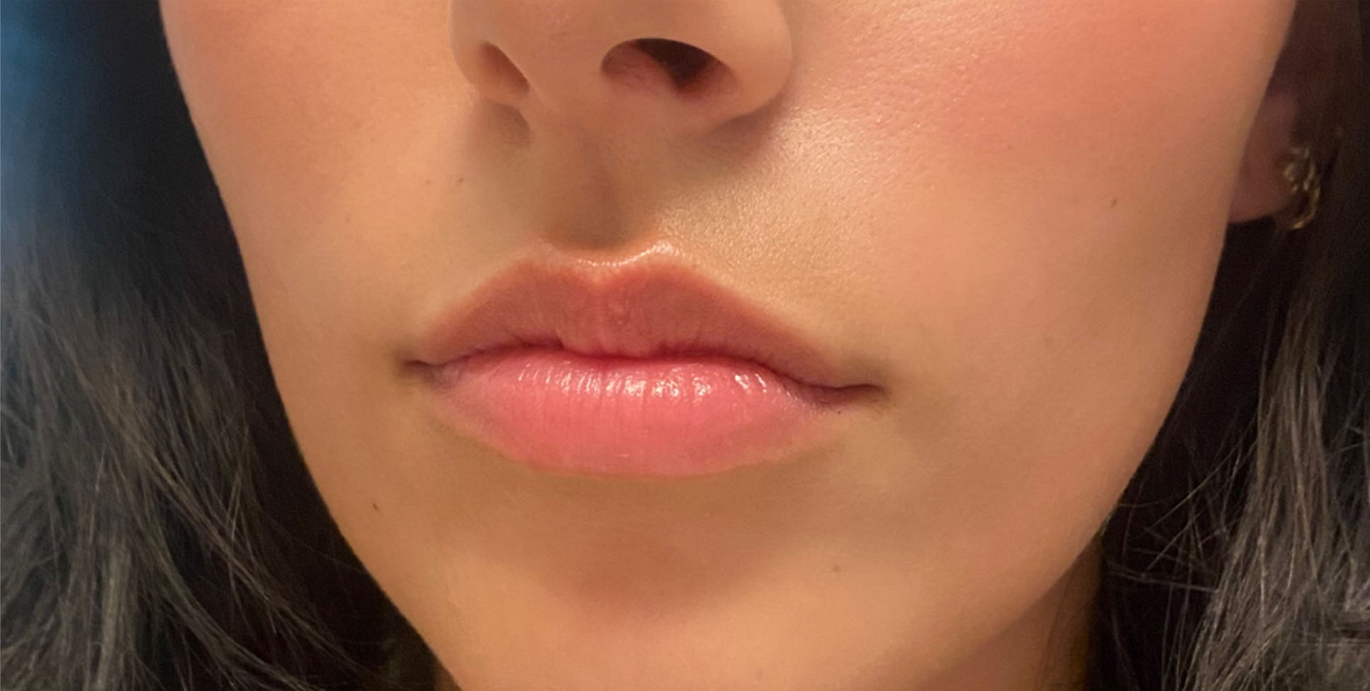 lip fillers in gilbert before